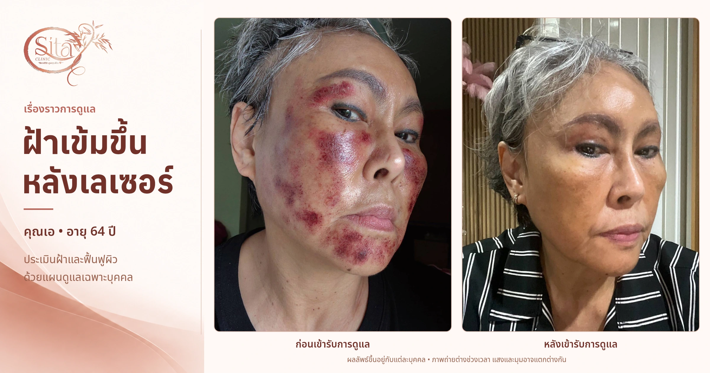 ฝ้าเข้มขึ้นหลังเลเซอร์อาจไม่ใช่ฝ้าเพียงอย่างเดียว อ่าน Patient Journey คุณเอ อายุ 64 ปี ตั้งแต่การทบทวนประวัติ ประเมินผิว จนถึงการติดตามฟื้นฟูอย่างเป็นระบบ